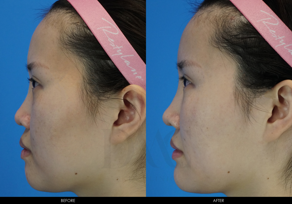 how to get rid of smile lines under nose