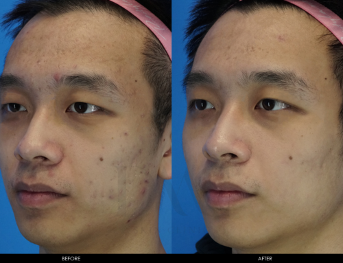 ACNE & ACNE SCAR IMPROVEMENT 2