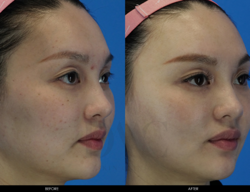 ACNE & ACNE SCAR IMPROVEMENT 4