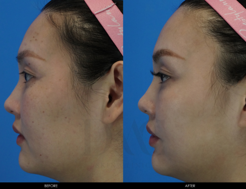 ACNE & ACNE SCAR IMPROVEMENT 1