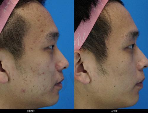 ACNE & ACNE SCAR IMPROVEMENT 5