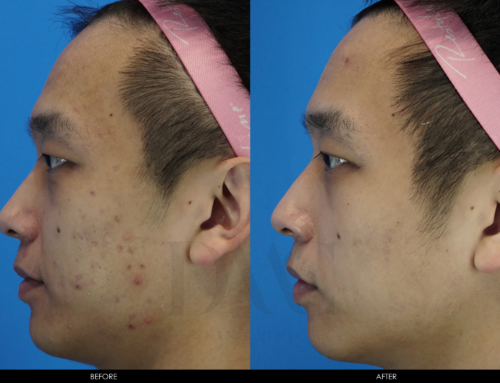 ACNE & ACNE SCAR IMPROVEMENT 1