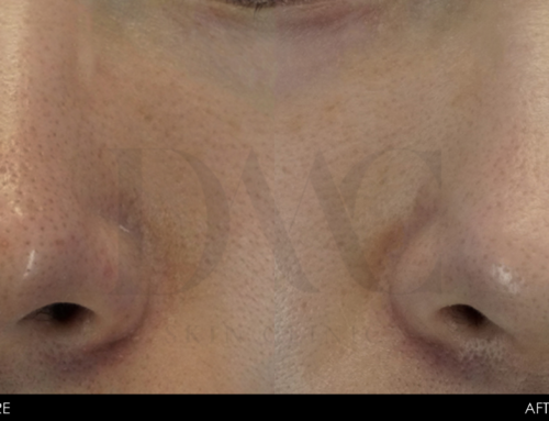 PORE & BLACKHEAD REDUCTION 3