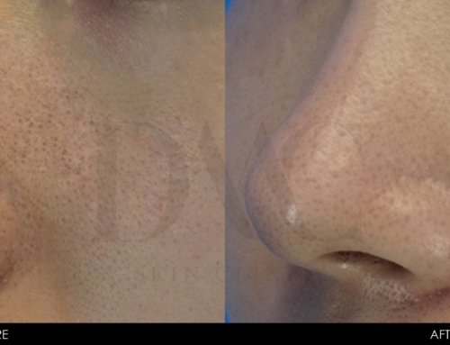 PORE & BLACKHEAD REDUCTION 2