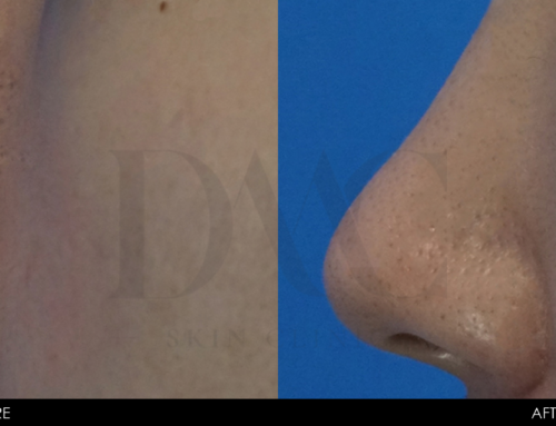 PORE & BLACKHEAD REDUCTION 1