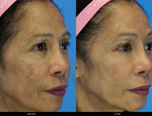 PIGMENTATION IMPROVEMENT 4