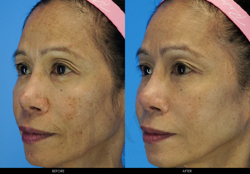 Pigmentation Improvement 2 - Dmc Skin Clinic