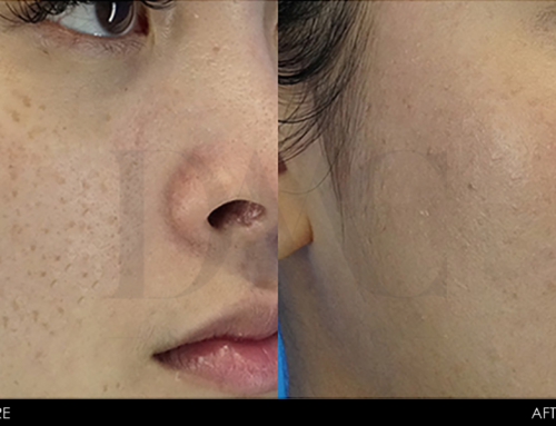 PIGMENTATION IMPROVEMENT 4