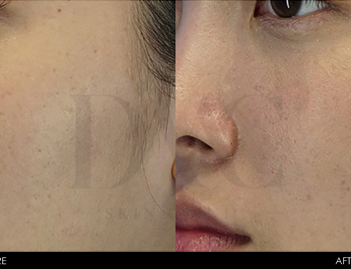 PIGMENTATION IMPROVEMENT 2